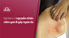 Giải thích rõ nguyên nhân viêm gan B gây ngứa da 