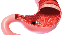 Viêm xung huyết dạ dày điều trị như thế nào?