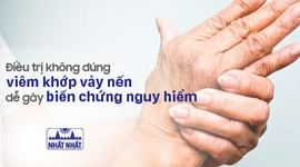 Điều trị không đúng viêm khớp vảy nến dễ gây biến chứng nguy hiểm