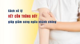Cách xử lý vết côn trùng đốt giúp giảm sưng ngứa nhanh chóng