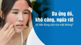 Da ửng đỏ, khô căng, ngứa rát có nên dùng sữa rửa mặt không?