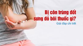 Bị côn trùng đốt sưng đỏ bôi thuốc gì? Giải đáp chi tiết