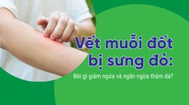 Vết muỗi đốt bị sưng đỏ: Bôi gì giảm ngứa và ngăn ngừa thâm da?