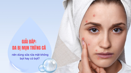 Giải đáp: Da bị mụn trứng cá nên dùng sữa rửa mặt không bọt hay có bọt?