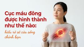 Cục máu đông được hình thành như thế nào: hiểu rõ sẽ cứu sống chính bạn
