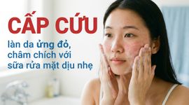 "Cấp cứu" làn da ửng đỏ, châm chích với sữa rửa mặt dịu nhẹ