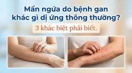 Mẩn ngứa do bệnh gan khác gì dị ứng thông thường? 3 khác biệt phải biết