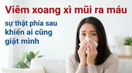 Viêm xoang xì mũi ra máu - sự thật phía sau khiến ai cũng giật mình