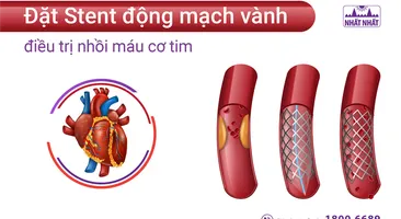 Đặt Stent động mạch vành điều trị nhồi máu cơ tim