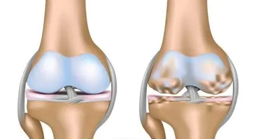Viêm khớp gối có dịch: Những biến chứng không thể lơ là!