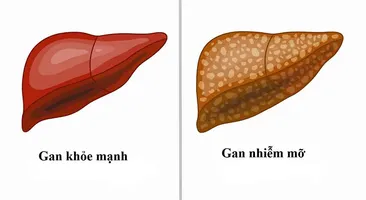 Gan nhiễm mỡ nhẹ: Dấu hiệu nhận biết và cách bảo vệ gan