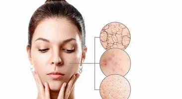Cách chăm sóc da hỗn hợp bị mụn, giúp làn da luôn khỏe đẹp