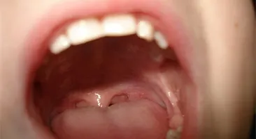 Loét vòm miệng do nhiệt miệng hay dấu hiệu bệnh lý nguy hiểm?