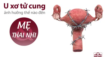 U xơ tử cung ảnh hưởng thế nào đến mẹ và thai nhi