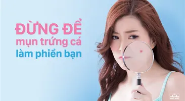 Đừng để mụn trứng cá làm phiền bạn