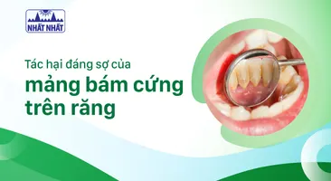 Tác hại đáng sợ của mảng bám cứng trên răng