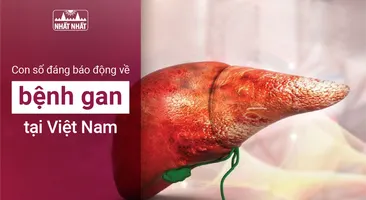 Con số đáng báo động về bệnh gan tại Việt Nam