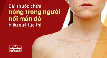 Bài thuốc chữa nóng trong người nổi mẩn đỏ hiệu quả tức thì