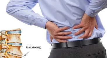 Bệnh gai cột sống thắt lưng – Giải pháp điều trị ít người biết!