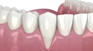 Bị tụt lợi nên uống thuốc gì? Chăm sóc răng miệng để ngăn ngừa tụt lợi
