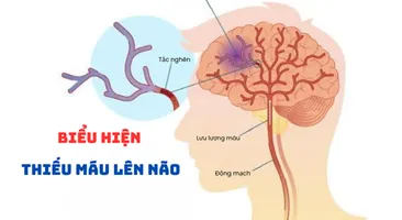 Biểu hiện của thiếu máu lên não: Đừng bỏ qua!
