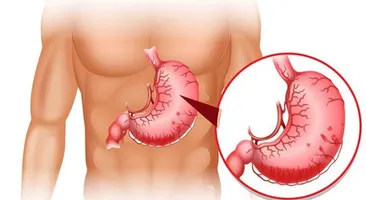 Cách trị đau bao tử: Giảm đau và bảo vệ dạ dày