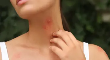 Làm thế nào để xử lý khi bị côn trùng cắn nổi mụn nước?