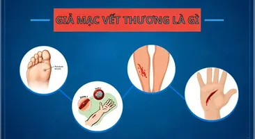 Giả mạc vết thương là gì: Tìm hiểu về lớp màng bảo vệ vết thương