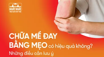 Chữa mề đay bằng mẹo có hiệu quả không? Những điều cần lưu ý
