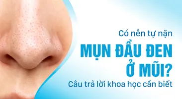 Có nên tự nặn mụn đầu đen ở mũi: Câu trả lời khoa học cần biết
