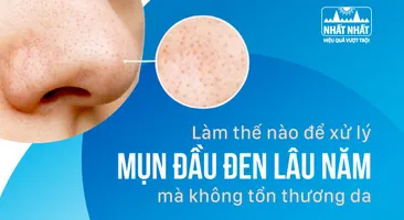 Làm thế nào để xử lý mụn đầu đen lâu năm mà không tổn thương da
