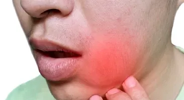 Viêm lợi sưng má: Đừng chủ quan kẻo ân hận!