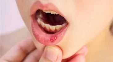 Nhiệt miệng ở trẻ em – Không nên chủ quan! 