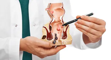 Trĩ nội độ 2: Hiểu đúng và điều trị kịp thời