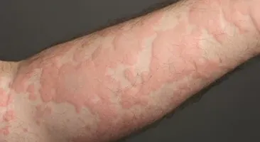 Nổi mẩn ngứa thành mảng khắp người: Có cách nào giảm ngứa nhanh?