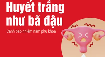 Huyết trắng vón cục như bã đậu: Cảnh báo nhiễm nấm phụ khoa