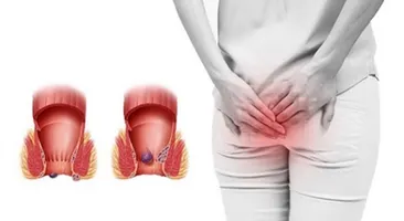 Giải đáp nhanh: Người bị trĩ nội nên kiêng gì?