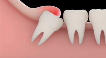 Sưng nướu răng khôn: Cách khắc phục ngay tại nhà