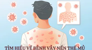 Vảy nến thể mủ: Cách điều trị và ngăn ngừa sẹo hiệu quả cao