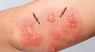 Giải đáp nhanh thắc mắc: Kiến ba khoang đốt có để lại sẹo không?