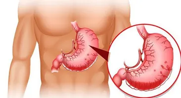 Giải đáp: Viêm dạ dày HP âm tính phải làm sao?