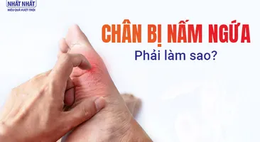 Giải đáp nhanh thắc mắc: Chân bị nấm ngứa phải làm sao?