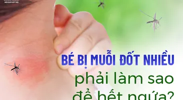 Bé bị muỗi đốt nhiều phải làm sao để hết ngứa?