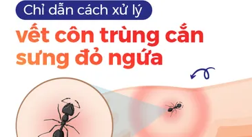 Chỉ dẫn cách xử lý vết côn trùng cắn sưng đỏ ngứa