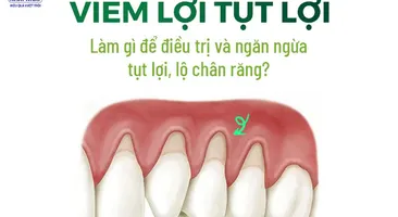 Viêm lợi tụt lợi: Làm gì để điều trị và ngăn ngừa tụt lợi, lộ chân răng?
