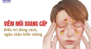 Viêm mũi xoang cấp: Điều trị đúng cách, ngăn chặn biến chứng