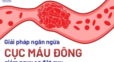 Áp dụng ngay giải pháp ngăn ngừa cục máu đông, giảm nguy cơ đột quỵ