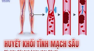 Huyết khối tĩnh mạch sâu: Các dấu hiệu điển hình và biện pháp điều trị hiệu quả