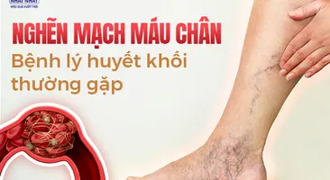 Nghẽn mạch máu chân: Bệnh lý huyết khối thường gặp