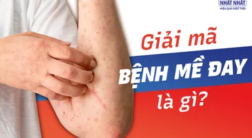 Giải mã bệnh mề đay là gì và cách khắc phục nhanh chóng nhất